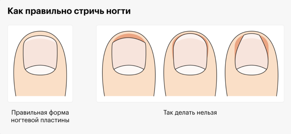 Как правильно стричь вросший ноготь. Как правильно стричь ногти. Как правильно пилить ногти. Как подпилить ногти красиво. Правильная форма ногтей на ногах.